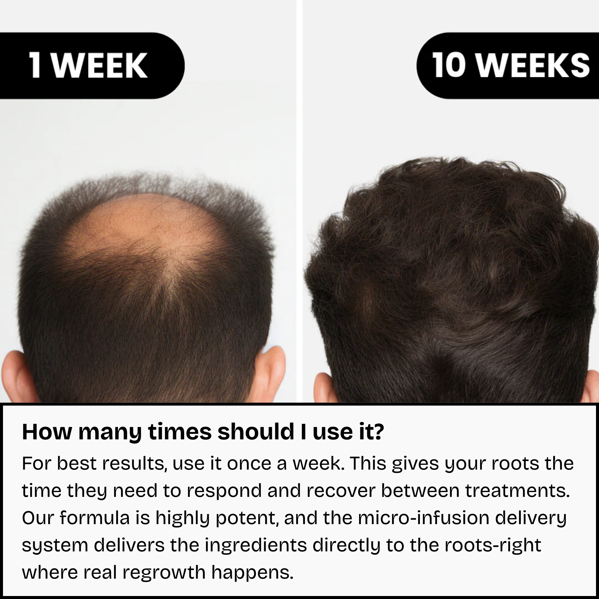 Hair Regrowth System