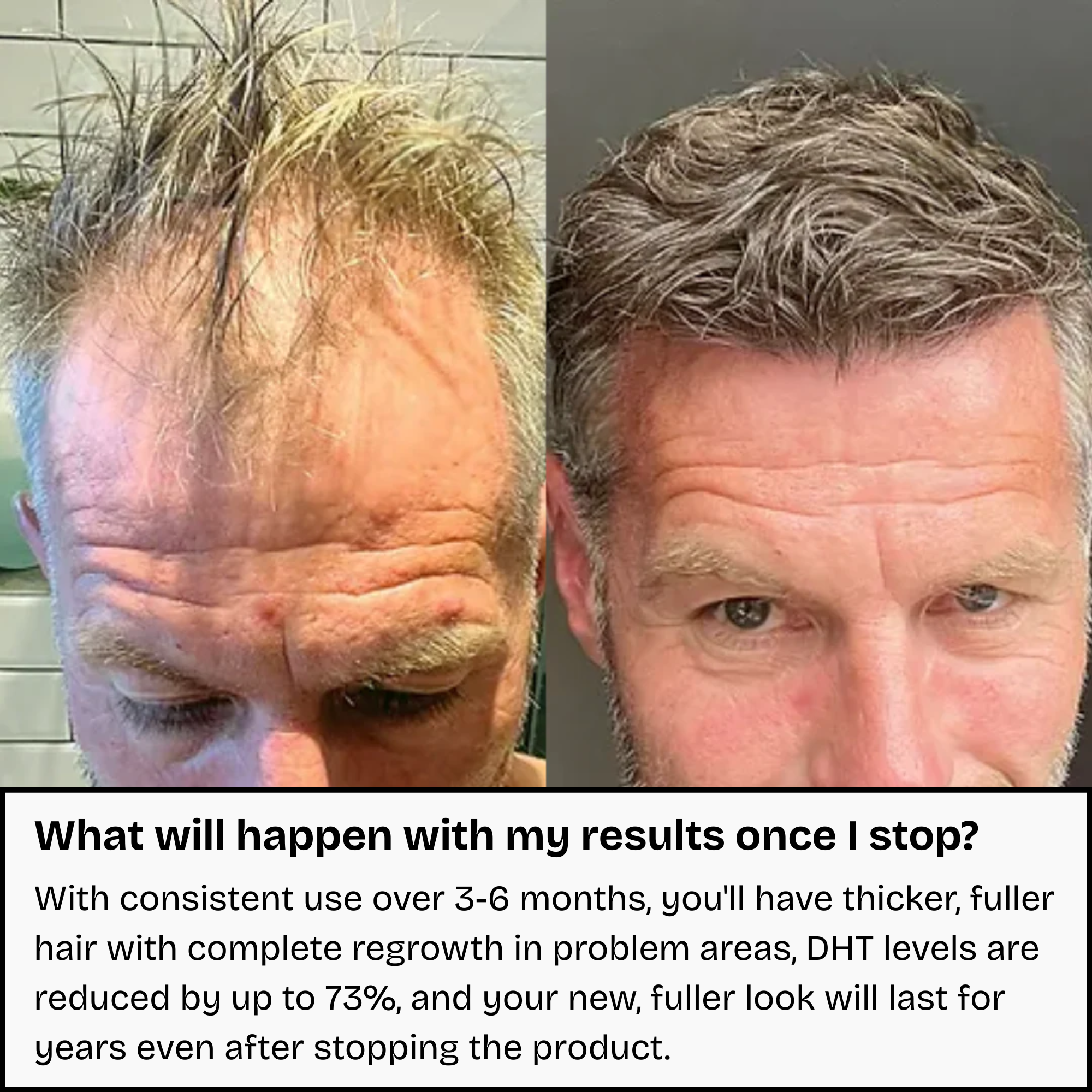 Hair Regrowth System